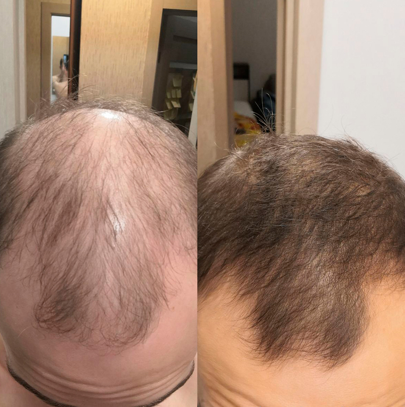 Процесс использования лосьона Hairland